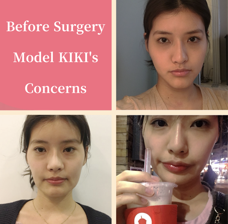 Photos of the model before her surgeries