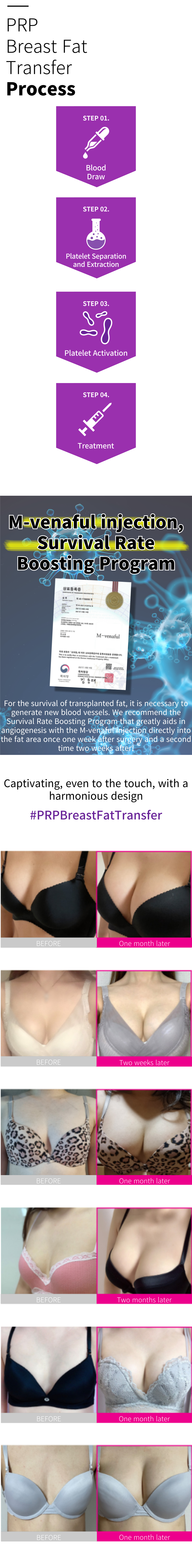 Introducing MIDAS PRP breast fat grafting